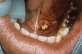 Salivary Stones